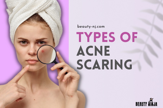 Types of Acne Scarring
