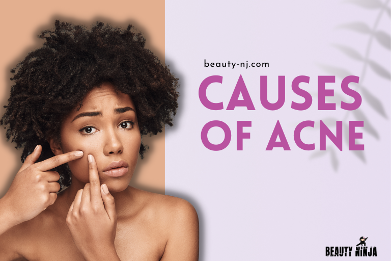 Causes of Acne