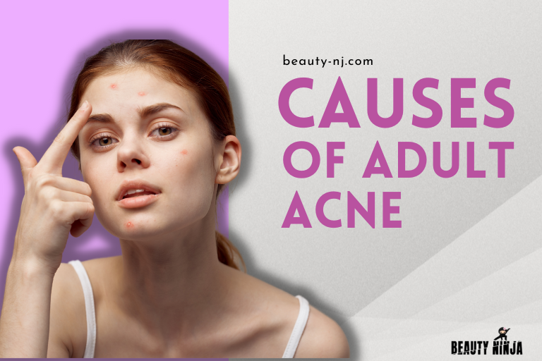 Cause of Acne in Adults 