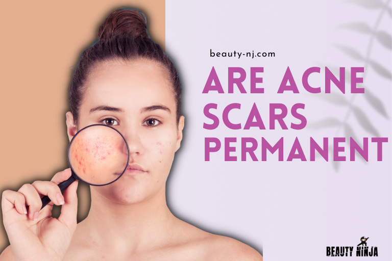 Are Acne Scars Permanent?